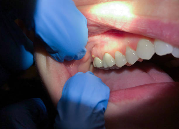 Best Emergency Tooth Extraction in Groveton, VA