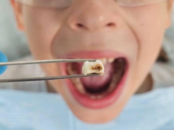 Best Emergency Tooth Extraction in Groveton, VA